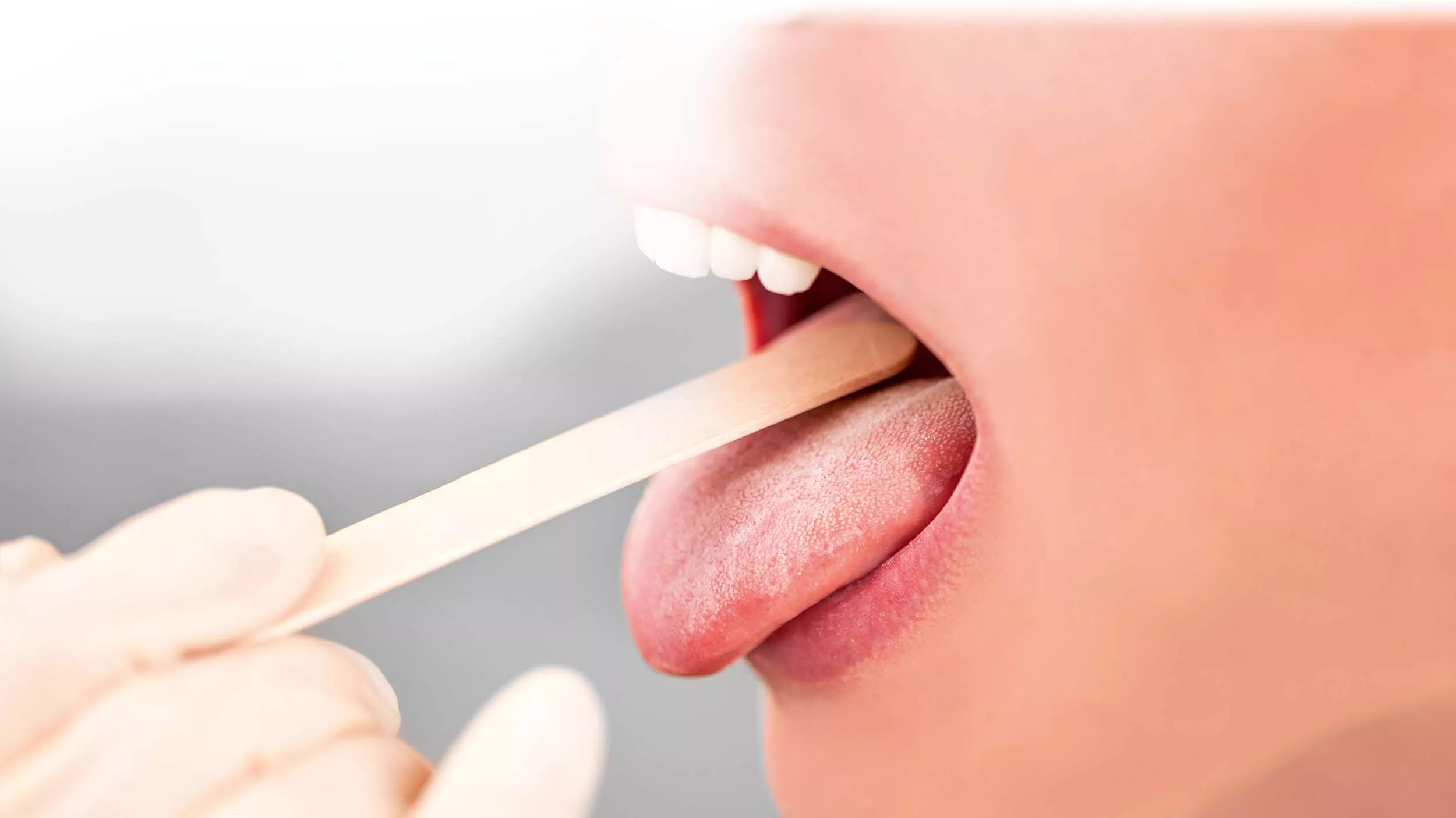 Wenn die Zunge brennt, könnte dahinter das Burning Mouth Syndrom stecken. Es handelt sich um eine Empfindungsstörung im Zungenbereich oder in der Mundschleimhaut.  - © eyetronic