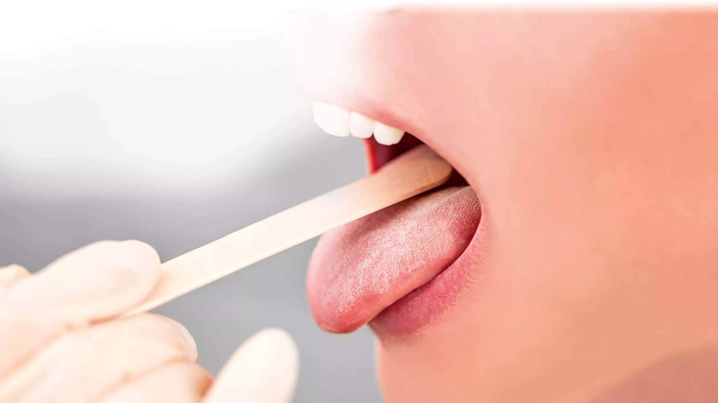 Wenn die Zunge brennt, könnte dahinter das Burning Mouth Syndrom stecken. Es handelt sich um eine Empfindungsstörung im Zungenbereich oder in der Mundschleimhaut.  - © eyetronic
